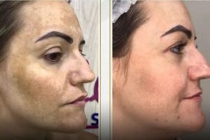 Peeling PDRN | Ativo derivado do DNA do salmão