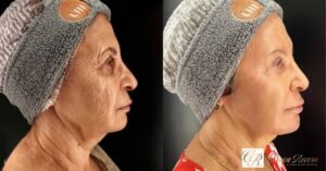 Creme coreano de PDRN com DNA do salmão Peptídeo 50g KOEC