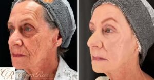 Peeling PDRN | Ativo derivado do DNA do salmão