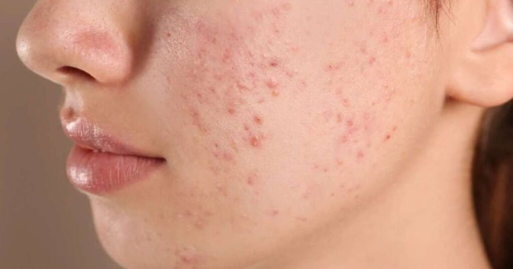 Fiz microagulhamento e minha pele manchou: Veja o que fazer
